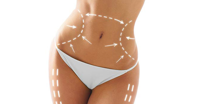 cryoliposculpt